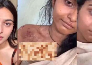 மார்பின் மீது கடுமையான காயம்