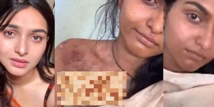 மார்பின் மீது கடுமையான காயம்