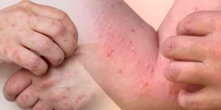 குழந்தைகளிடையே வேகமாக பரவும் நோய்கள்!