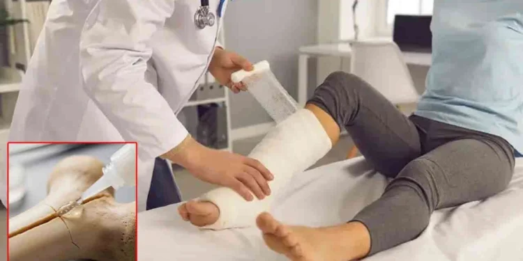 எலும்பு முறிவை 3 நிமிடத்தில் சரிசெய்யும் புதிய பசை கண்டுபிடிப்பு!