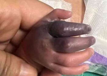 தவறான தடுப்பூசியால் பச்சிளம் குழந்தைக்கு நேர்ந்த கொடூரம்!