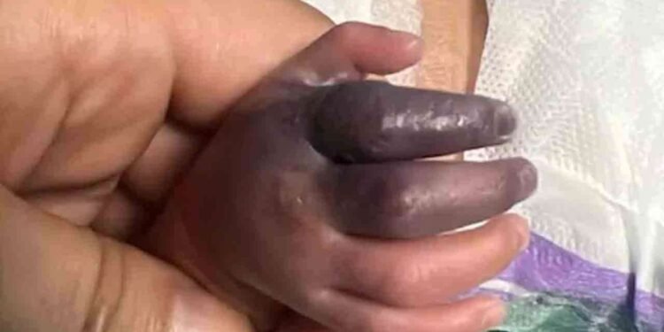 தவறான தடுப்பூசியால் பச்சிளம் குழந்தைக்கு நேர்ந்த கொடூரம்!